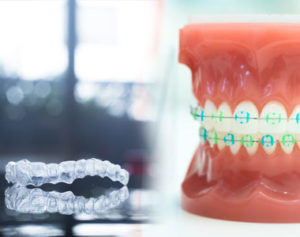 Braces vs Invisalign