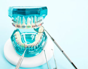 Benefits of Braces