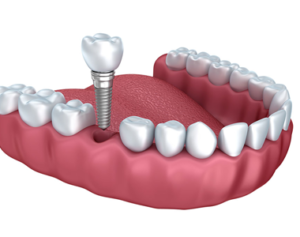 Dental Implants
