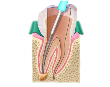 Root Canals: FAQs about treatment that can save your Tooth- treatment at gardencity  