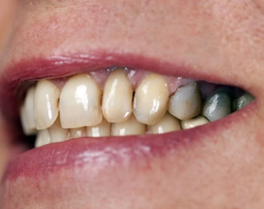 Causes of Tooth Decay- treatment at gardencity