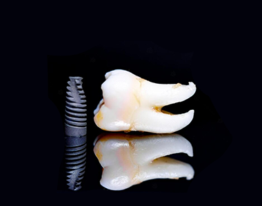 Zygomatic implants- treatment at gardencity  