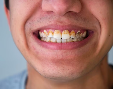 The Devastating Effects of Methamphetamine Use on Your Oral Health- treatment at gardencity  