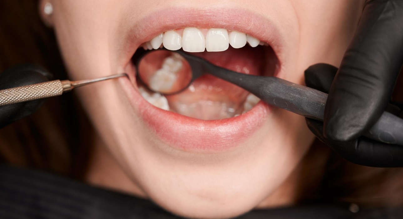 Tooth-Colored Fillings Image