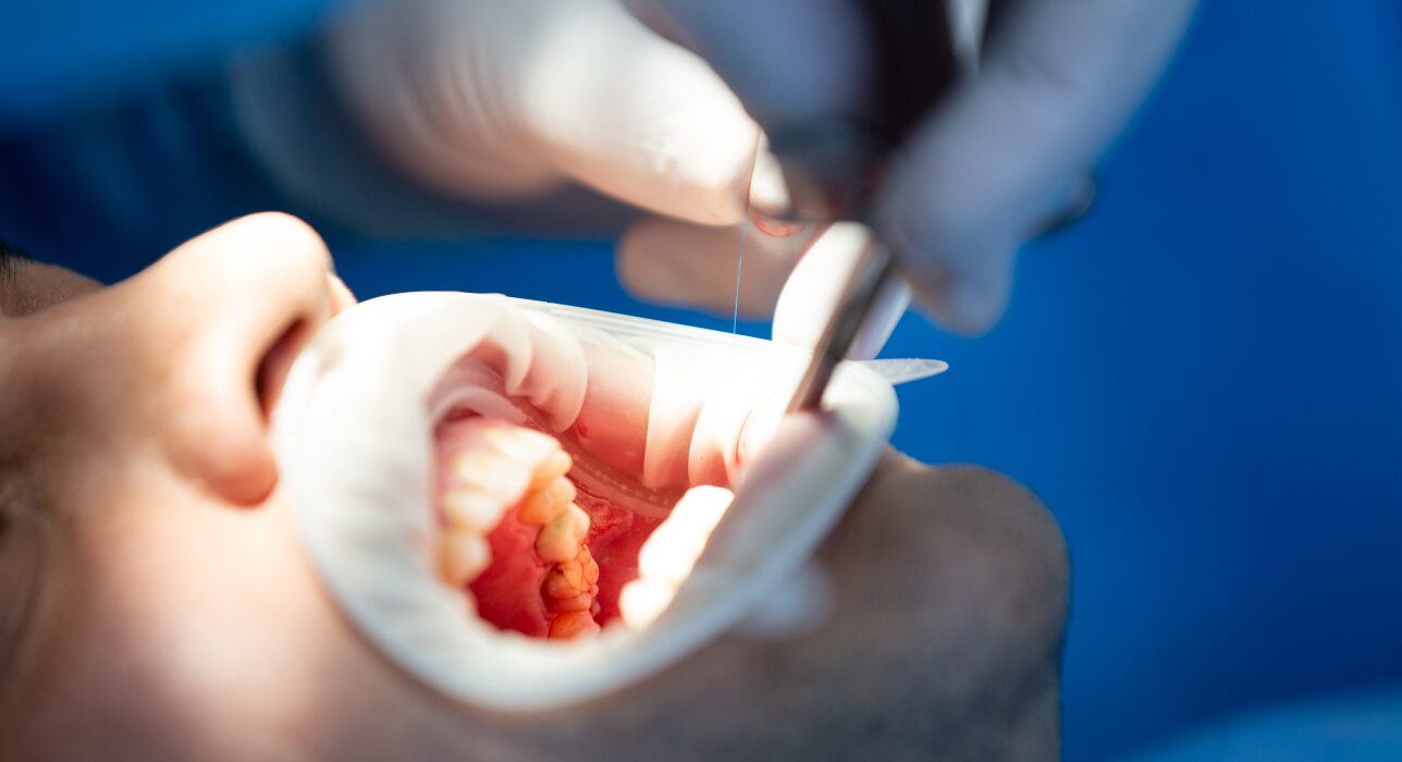 Wisdom Tooth extraction