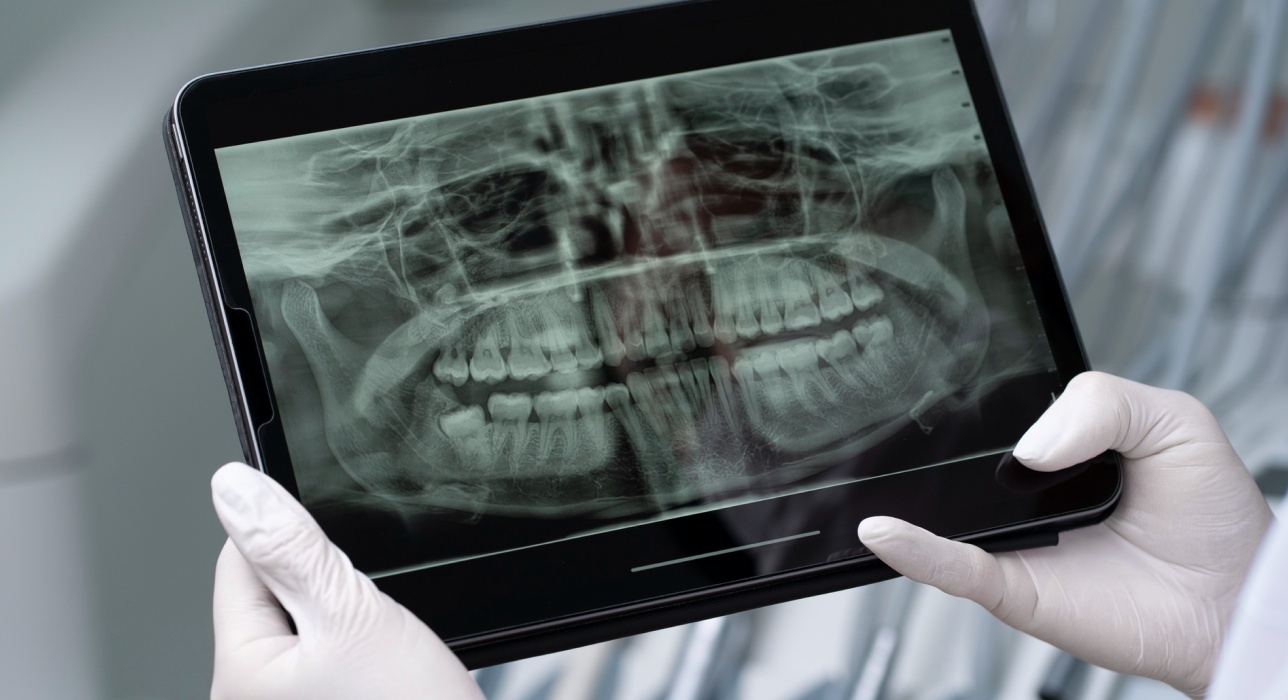 Digital X-ray evaluation for gum health